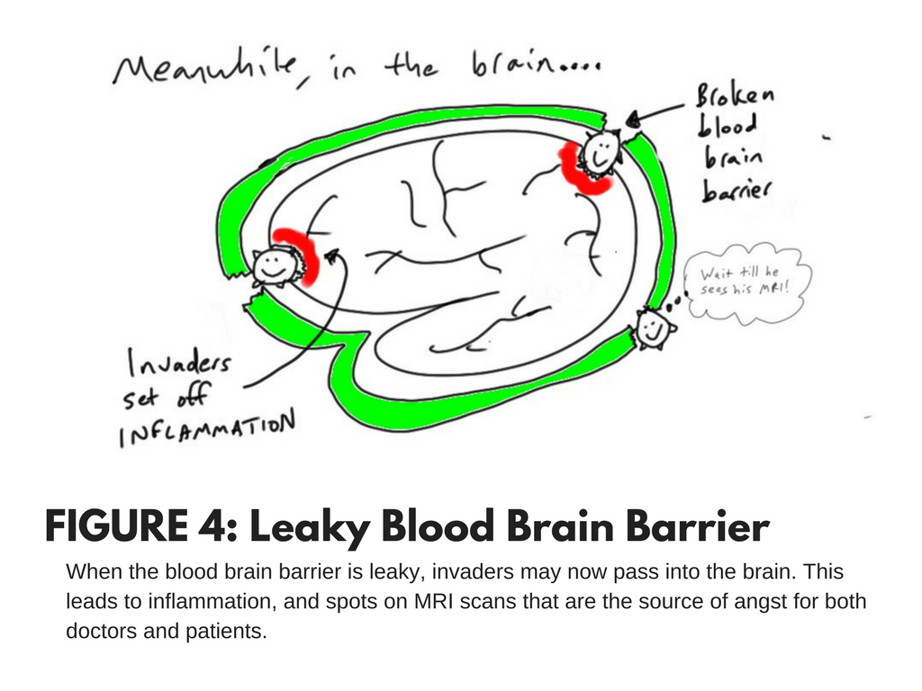 migraine and leaky brain