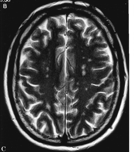 white matter spots in Celiac