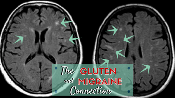 The Gluten & Migraine Connection, what you need to know